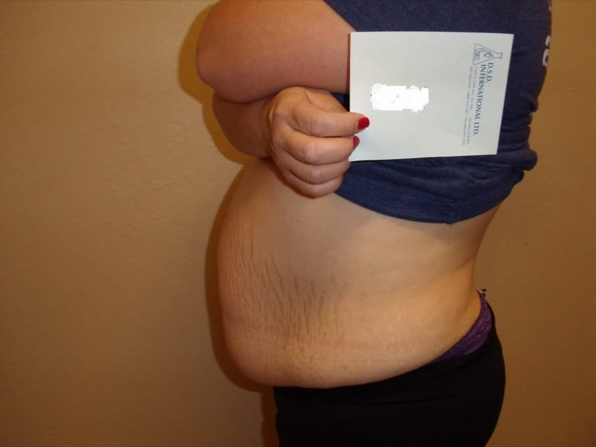 Side view of an actual LifeCare laser lipo patient's abdomen before treatment.