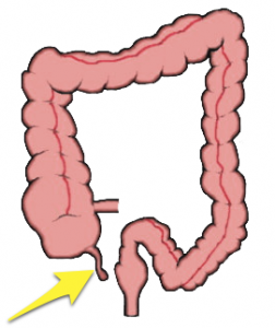 CT scan side effects-appendicitis