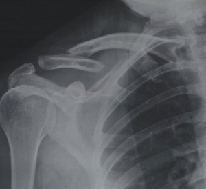 diabetes and osteoporosis linked