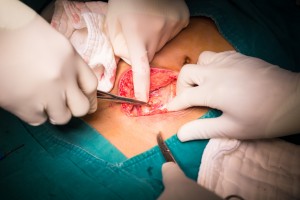 is surgery for appendicitis needed